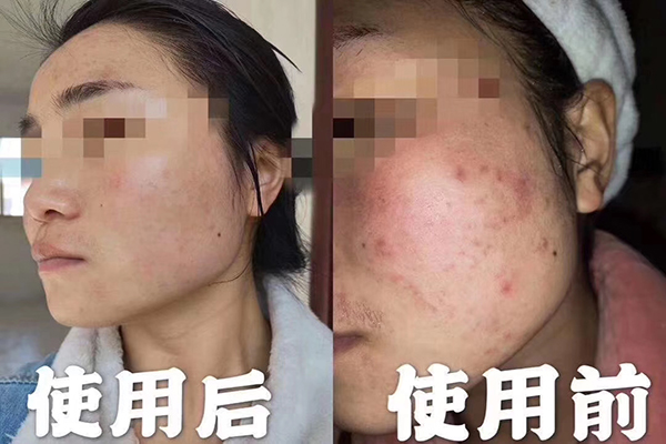 祛痘廠(chǎng)家:祛痘護膚品的成分解析-歐泉生化